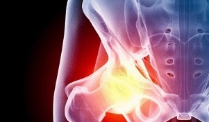 a csípőízület artrózisának kialakulásának okai