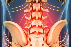 az osteochondrosis okai és tünetei