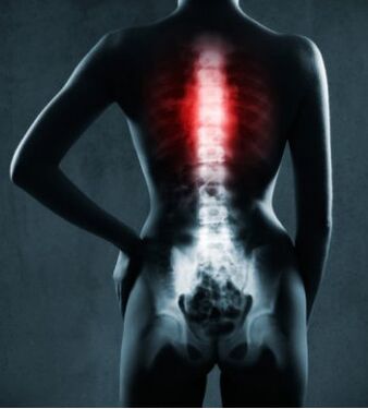 A gerinc érintett területe mellkasi osteochondrosisban