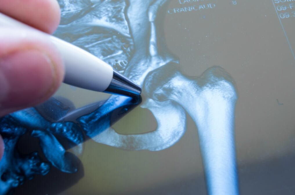 A csípőízület artrózisa a röntgenfelvételen