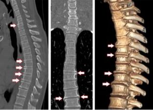 A mellkasi osteochondrosis 4. fokozata CT-felvételen