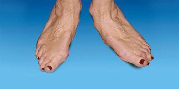 a láb deformitása a boka arthrosisával