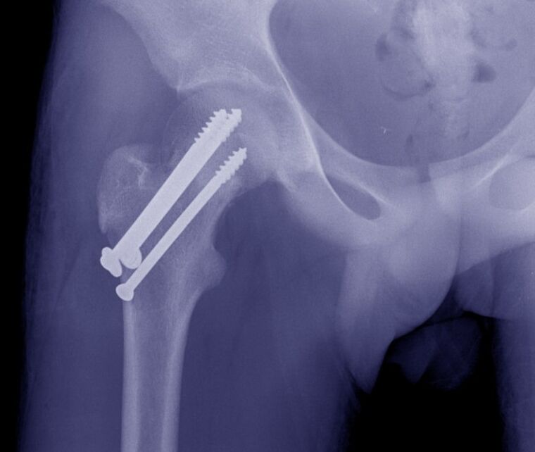 A csípőízület röntgenfelvétele, a törés oszteoszintézise belső rögzítő eszközökkel