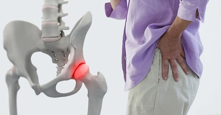 fájdalom a csípő területén - a csípőízület artrózisának tünete