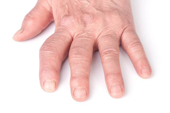 deformáló arthrosis a kezeken