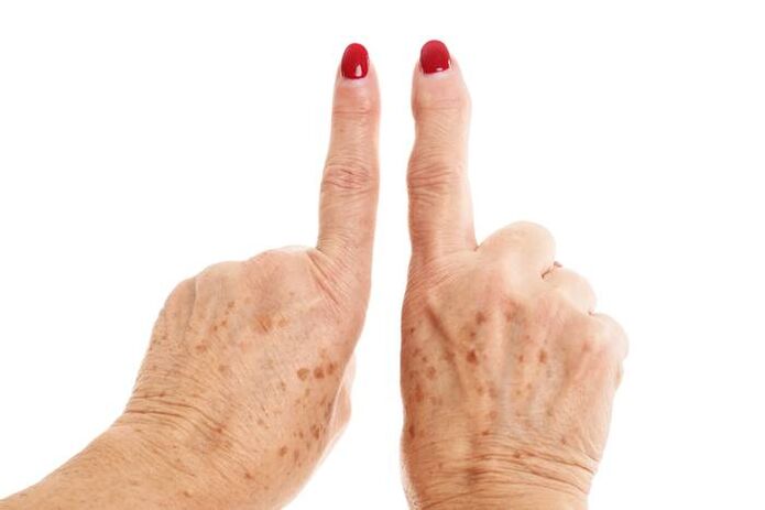 deformáló arthrosis az ujjakon
