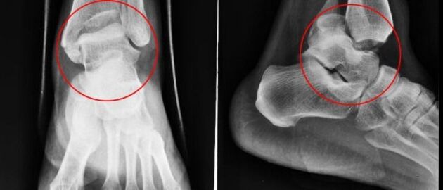 röntgenfelvétel a boka arthrosisára