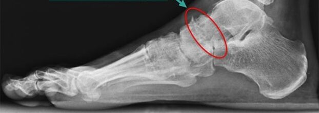 szcintigráfia a boka arthrosisára