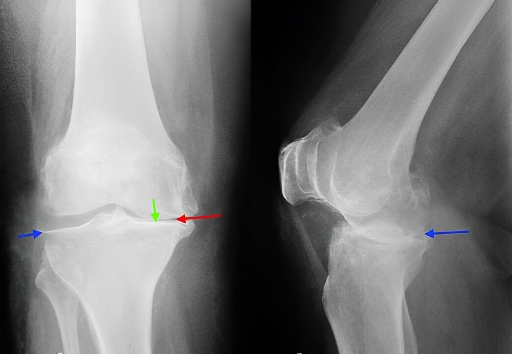 a térdízület arthrosisának röntgenfelvétele