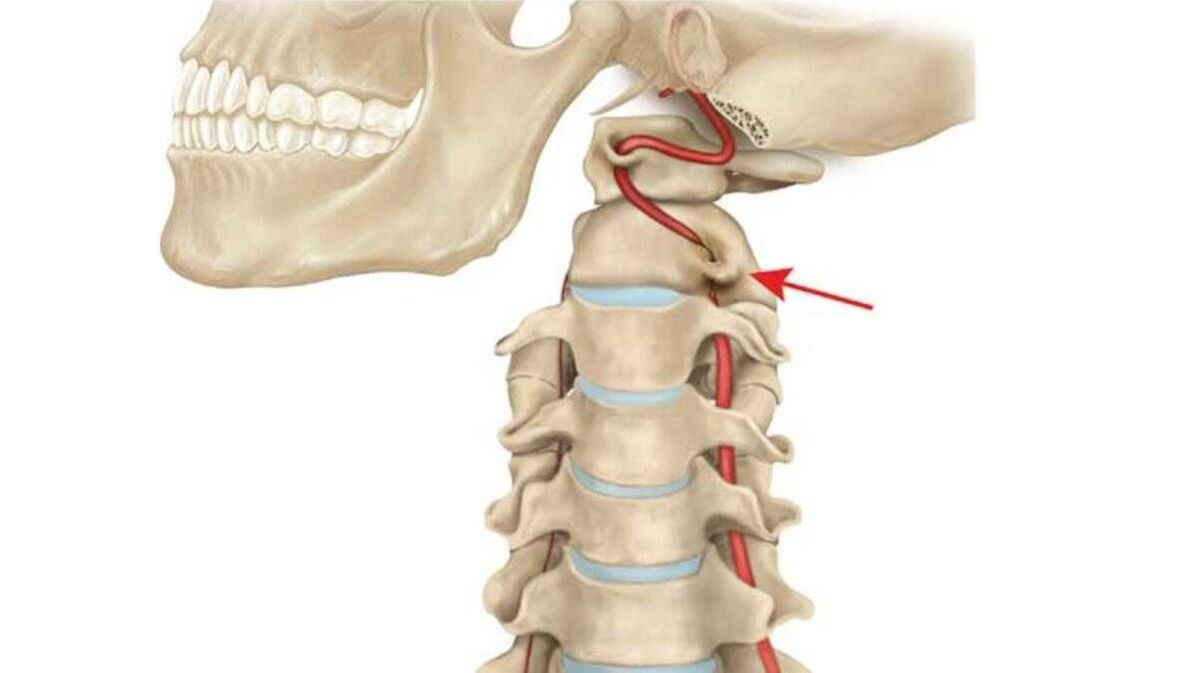 a nyaki gerinc osteochondrosisa
