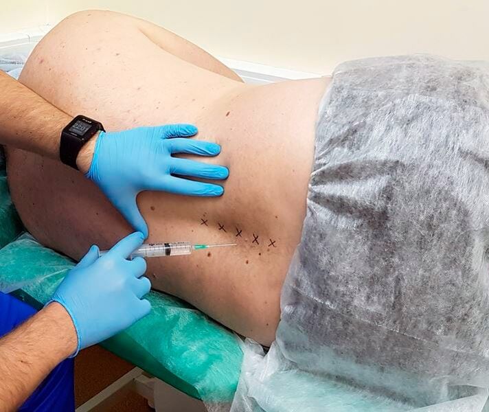 gyógyászati ​​blokádok a hát számára